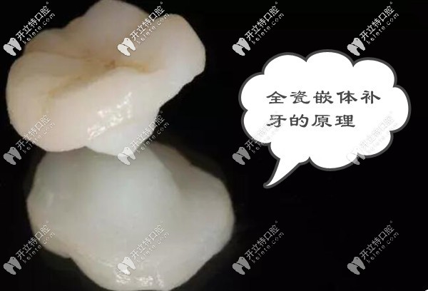 全瓷嵌体补牙的原理