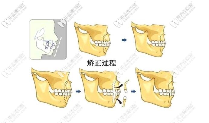 牙齿矫正过程