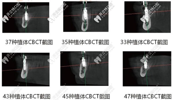 各牙齿种植体在CBCT中显示的样子