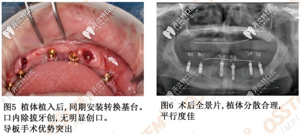 利用数字化导板植入植体更精准