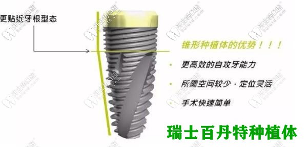 瑞士百丹特种植牙优势 瑞士百丹特种植牙优势