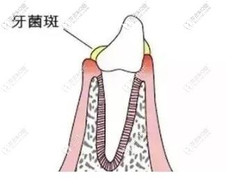 牙菌斑图片 牙菌斑图片