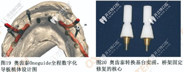 奥齿泰全程数字化导板植体设计图