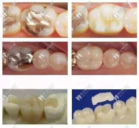 嵌体补牙材料
