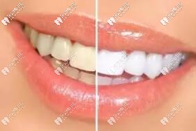牙齿美白 牙齿美白