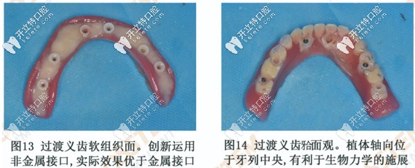 过渡义齿的制作