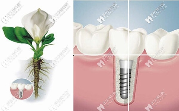 徐州口腔医院种一颗牙齿的价格多少钱