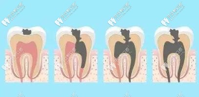龋齿发展过程 龋齿发展过程