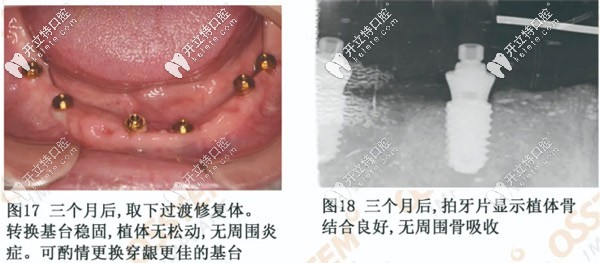 三个月后取下过渡义齿安装牙冠