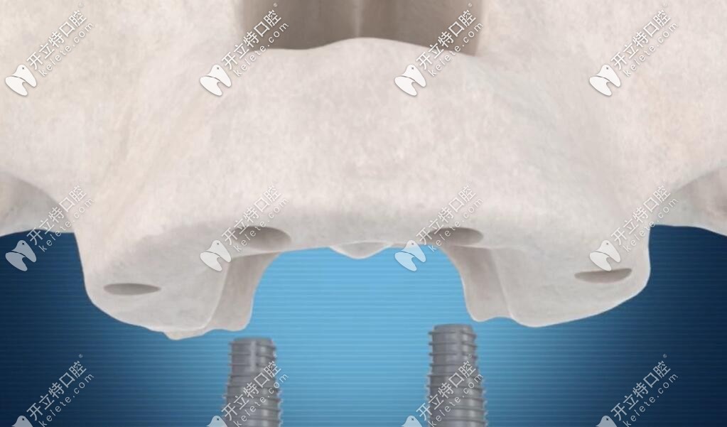 allon4种植牙先中2颗垂直植体