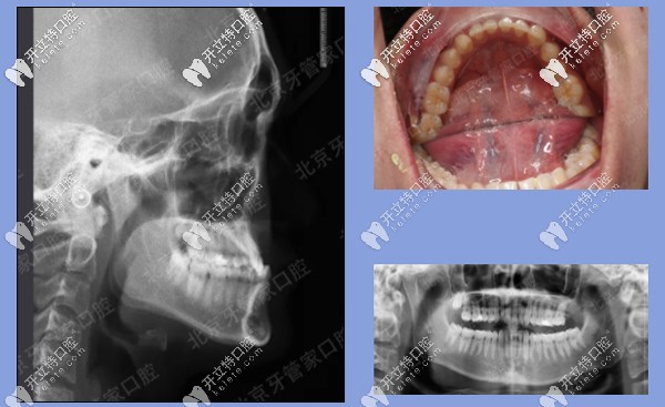 患者牙齿前期检查