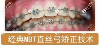 直丝弓矫治技术 直丝弓矫治技术
