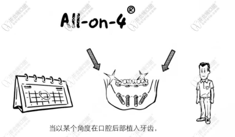 allon4种植牙漫画图