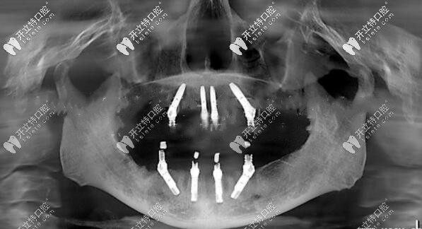 全口allon4种植牙后拍的CT