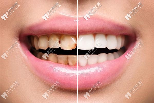 牙齿美白效果对比图