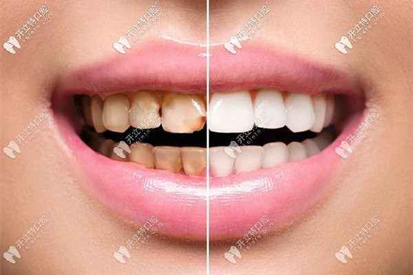 牙齿美白效果对比图 牙齿美白效果对比图