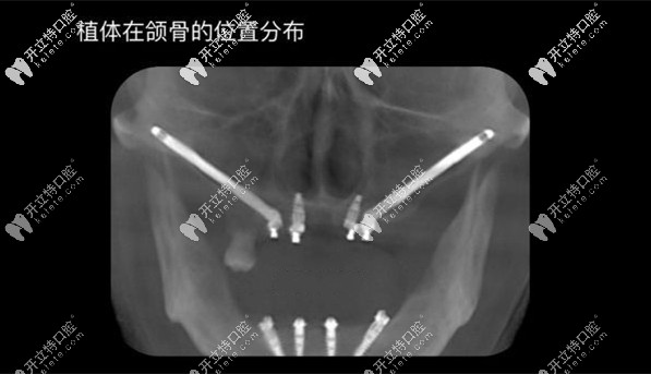 种植体在颌骨的位置分布图 种植体在颌骨的位置分布图