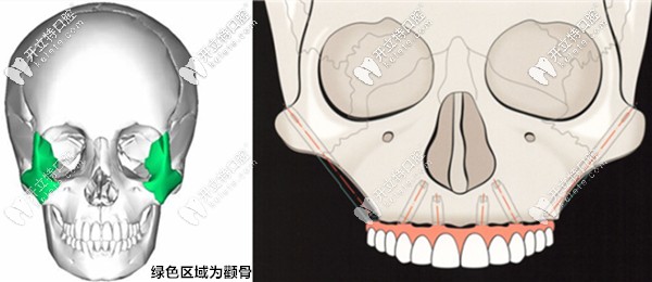 颧骨种植的示意图