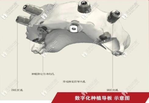 好大夫口腔:数字导板引导种植技术——告别传统“盲种” 好大夫口腔:数字导板引导种植技术——告别传统“盲种”