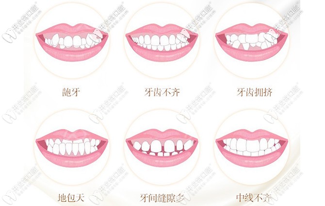 牙齿矫正的适应症