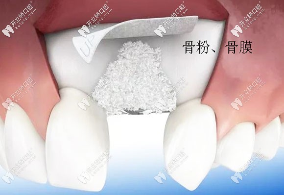 种植牙的骨粉骨膜材料