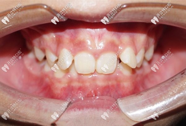 孩子的牙齿是这种深覆合症状