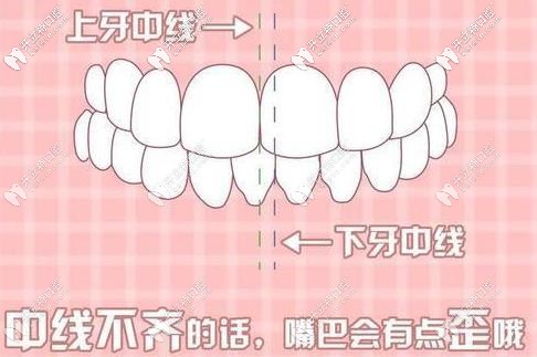 判断牙齿不齐的方式