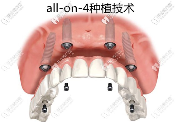 all-on-4半口种植牙修复