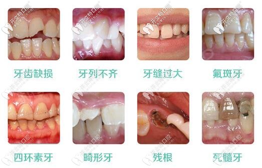 湘潭赖尔口腔：哪些牙齿情况要做全瓷牙