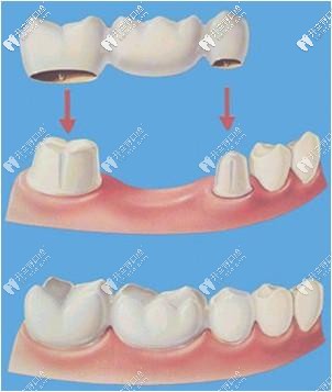 连桥冠修复外观示意图