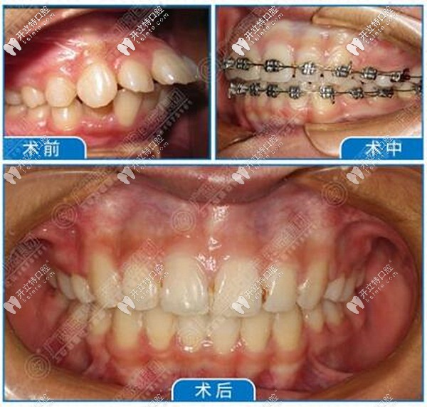 玉林蓝天口腔医院正畸效果好吗?总店牙齿矫正收费标准是