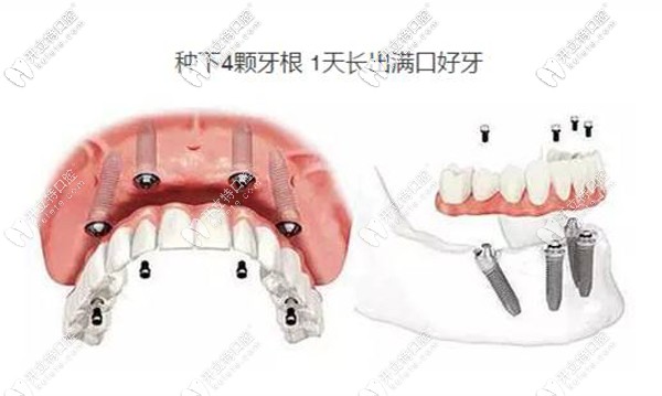 ALL- on-4种植牙技术