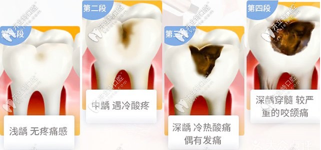 形成蛀牙的过程