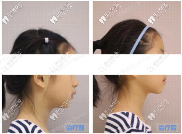 儿童深覆合矫正前后脸型对比