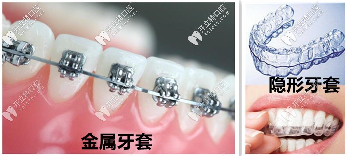 矫正牙齿：来湘潭赖尔牙科，选择合适你的牙套吧！