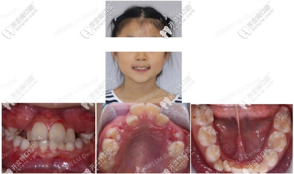 10岁女孩牙齿深覆合矫正前的照片
