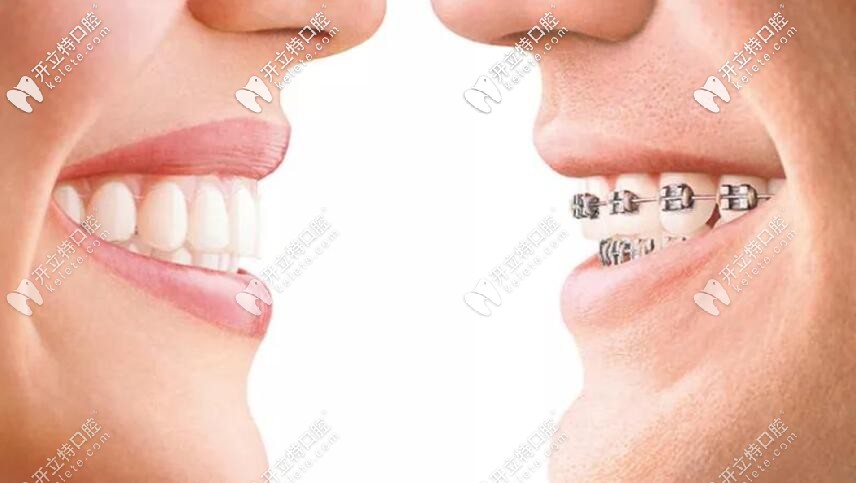 各类型牙齿矫正技术