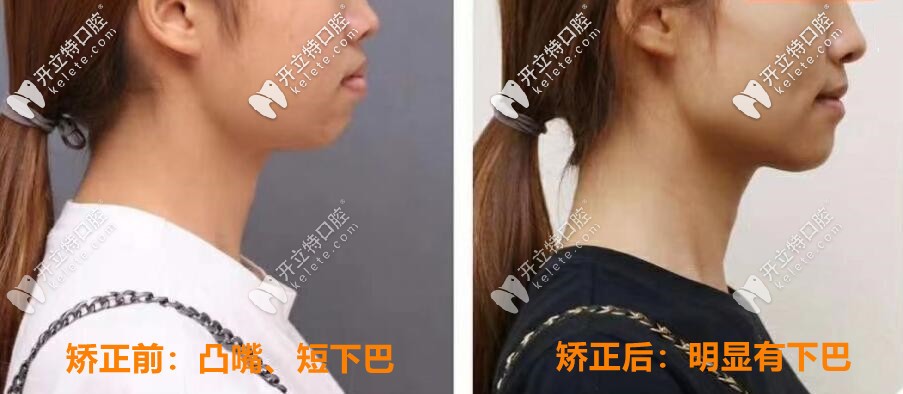 矫正前后对比照片：明显有下巴，侧颜好看