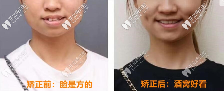 00后妹子：轻度骨性凸嘴2年矫正完成