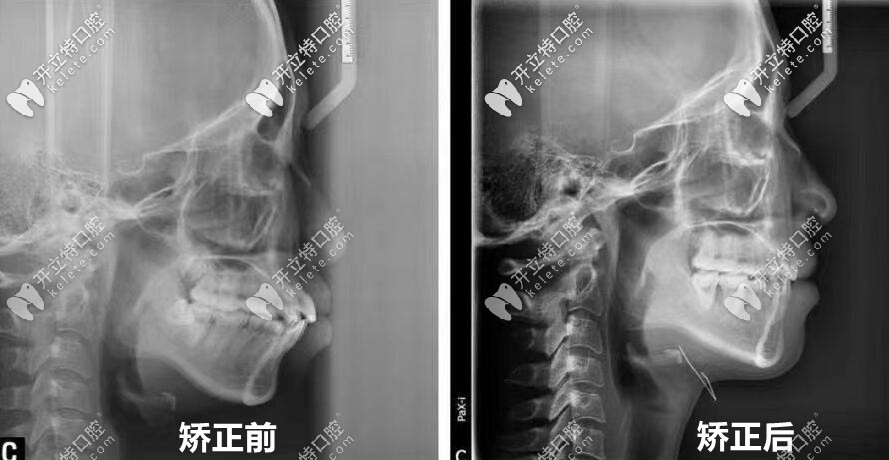00后妹子：正畸前后全牙和头颅侧位片对比