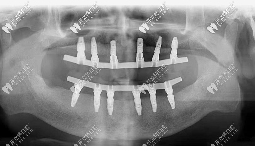 北京美铭口腔爷爷在北京平谷美铭做的allon6全口种植牙,上下各打了6个钉