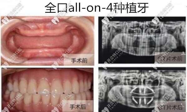 深圳美莱口腔周炜院长全口种植牙<span style=