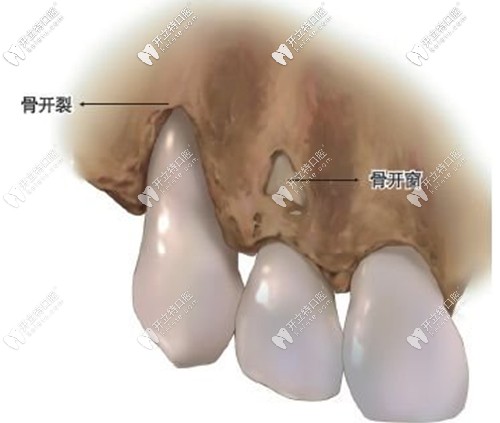 正畸中骨开窗或骨开裂示意图