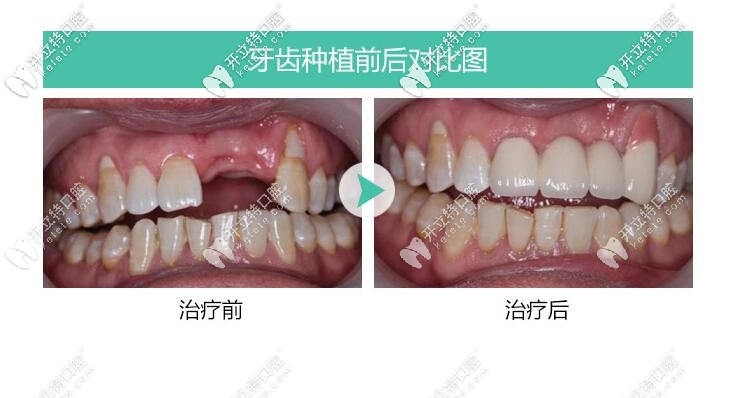 前牙美学种植修复案例