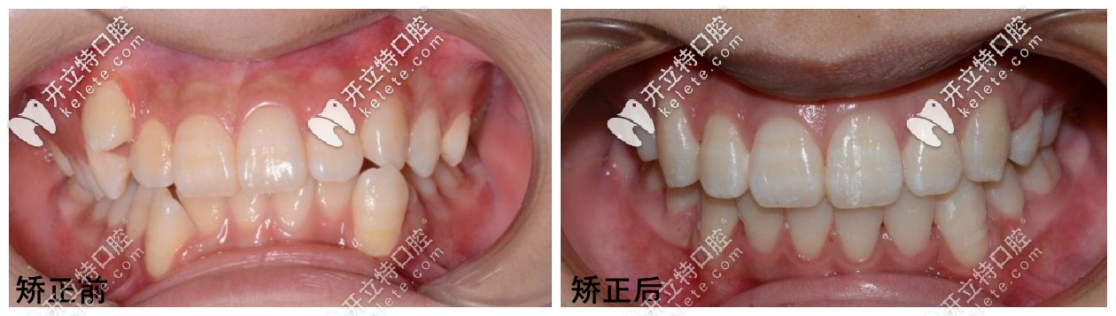 洛阳维乐口腔矫正案例