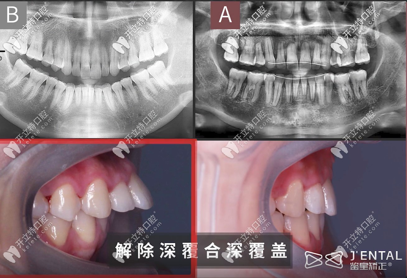 牙齿内收7mm，顺便解决了10mm的露龈笑