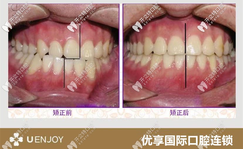 张医生:独特设计中线偏离矫正案例 张医生:独特设计中线偏离矫正案例