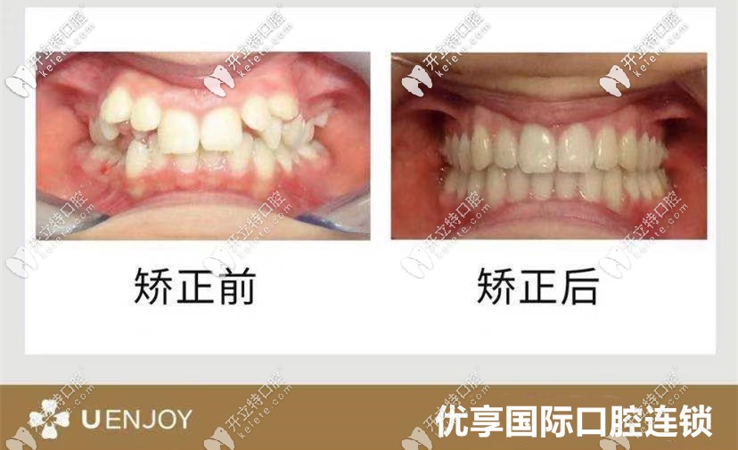 龅牙妹妹牙齿矫正前后变化图 龅牙妹妹牙齿矫正前后变化图