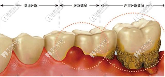 牙龈萎缩发展趋势图