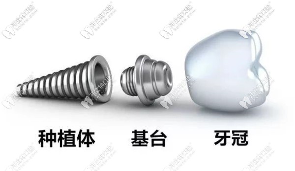 种植牙由种植牙、基台及牙冠组成 种植牙由种植牙、基台及牙冠组成